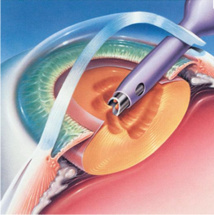 L'intervention chirurgicale L'intervention chirurgicale