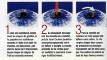 La chirurgie au laser excimer La chirurgie au laser excimer